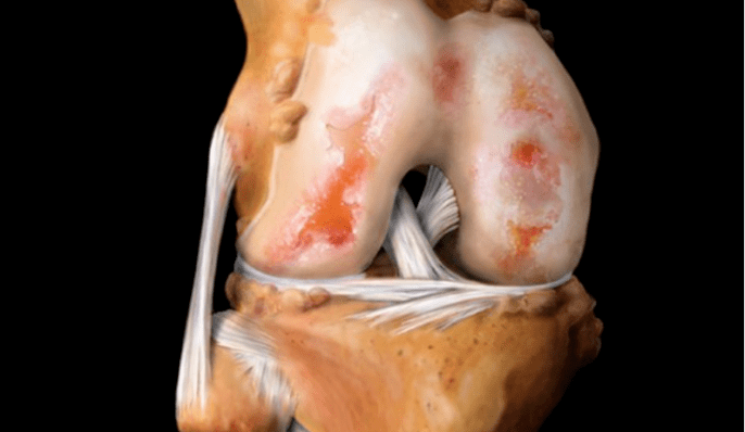 knee joint osteoarthritis