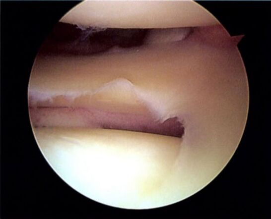 Torn meniscus leading to knee osteoarthritis