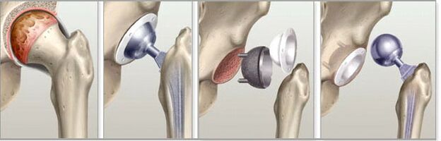 hip arthroplasty for osteoarthritis