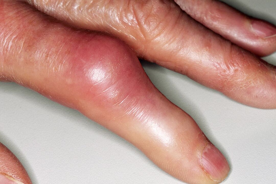 Swelling, deformation of the finger joint and sharp pain after injury