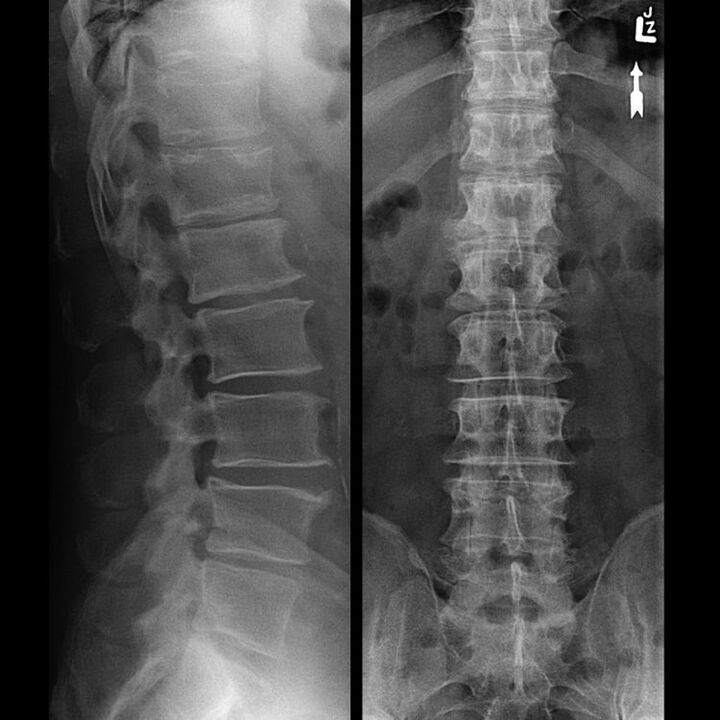 Spine suspension with osteochondrosis
