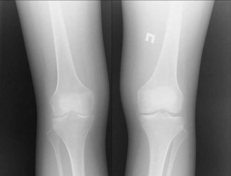 X-ray of knees affected by osteoarthritis