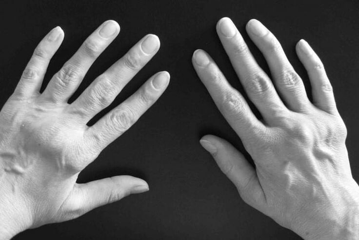 arthritis symptoms in hand joints