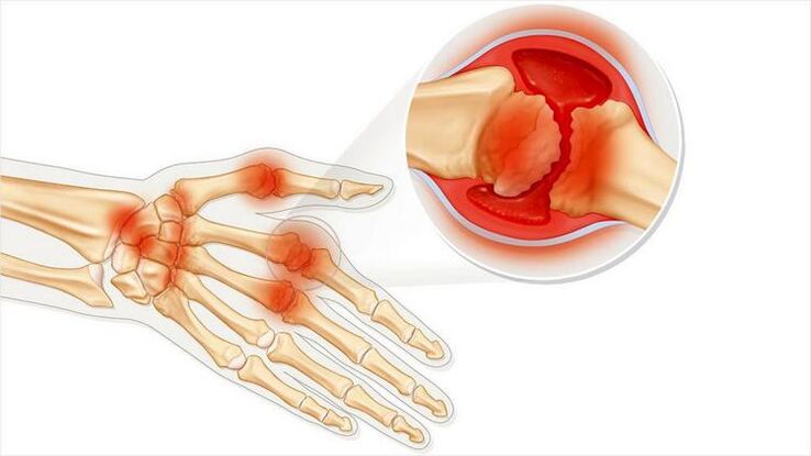hand joint damage due to arthritis