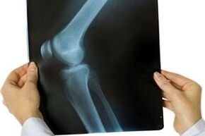 arthrosis of the knee joint on x-ray