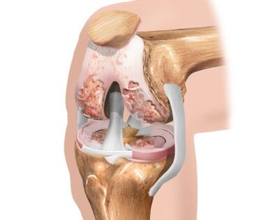 destruction of the knee joint due to osteoarthritis