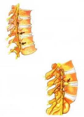 spinal osteochondrosis illustration
